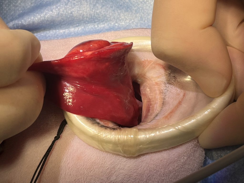 胸腔鏡下（補助下）肺葉切除